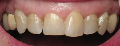 All Dental work by Dr. Thomas M. Green and Haupt Dental Lab.