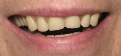 All Dental work by Dr. Thomas M. Green and Haupt Dental Lab.