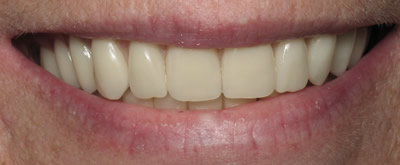 All Dental work by Dr. Thomas M. Green and Haupt Dental Lab.