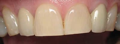 All Dental work by Dr. Thomas M. Green and Haupt Dental Lab.