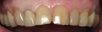 All Dental work by Dr. Thomas M. Green and Haupt Dental Lab.