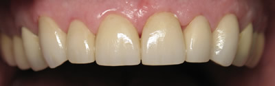 All Dental work by Dr. Thomas M. Green and Haupt Dental Lab.