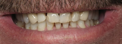 All Dental work by Dr. Thomas M. Green and Haupt Dental Lab.